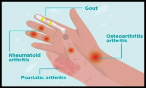 ¿Qué es y cómo tratar la artritis reumatoide